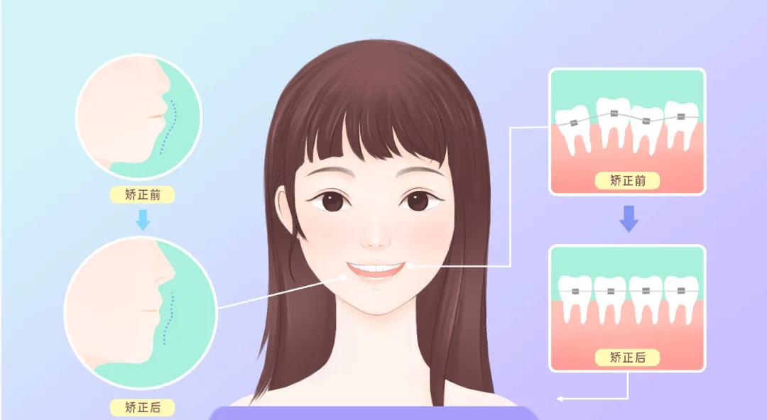 戴牙套≠钢牙妹丨有一种选择叫隐形矫正
