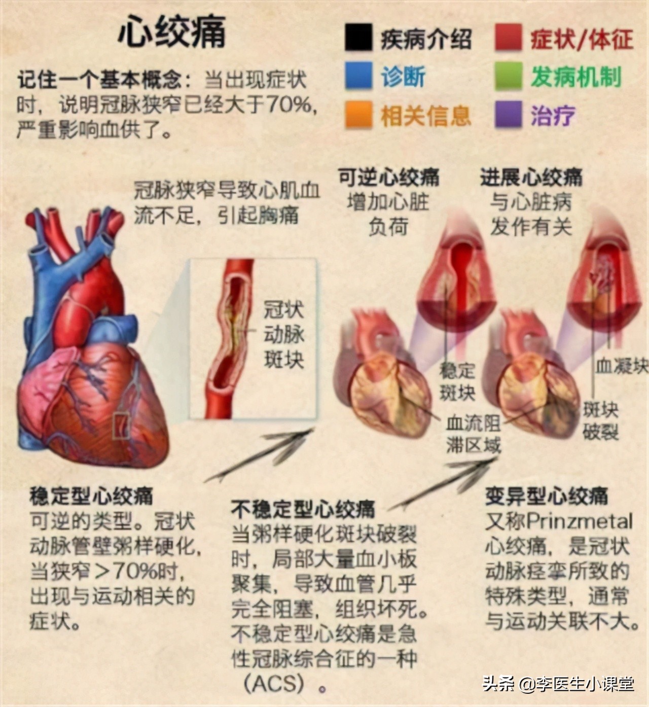“速效救心丸”和“硝酸甘油”，谁才能紧急救命？吃错反而更伤身