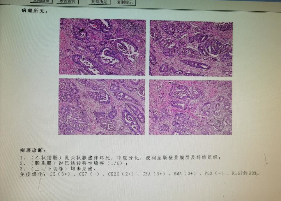 出現便血，是腸癌還是痔瘡？ 醫生教你從三方面辨別，別再混淆了