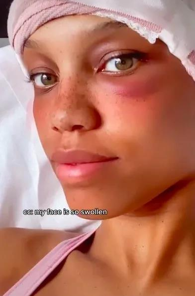 妹纸嫌额头巨大，去做缩额术，将发际线拉低3厘