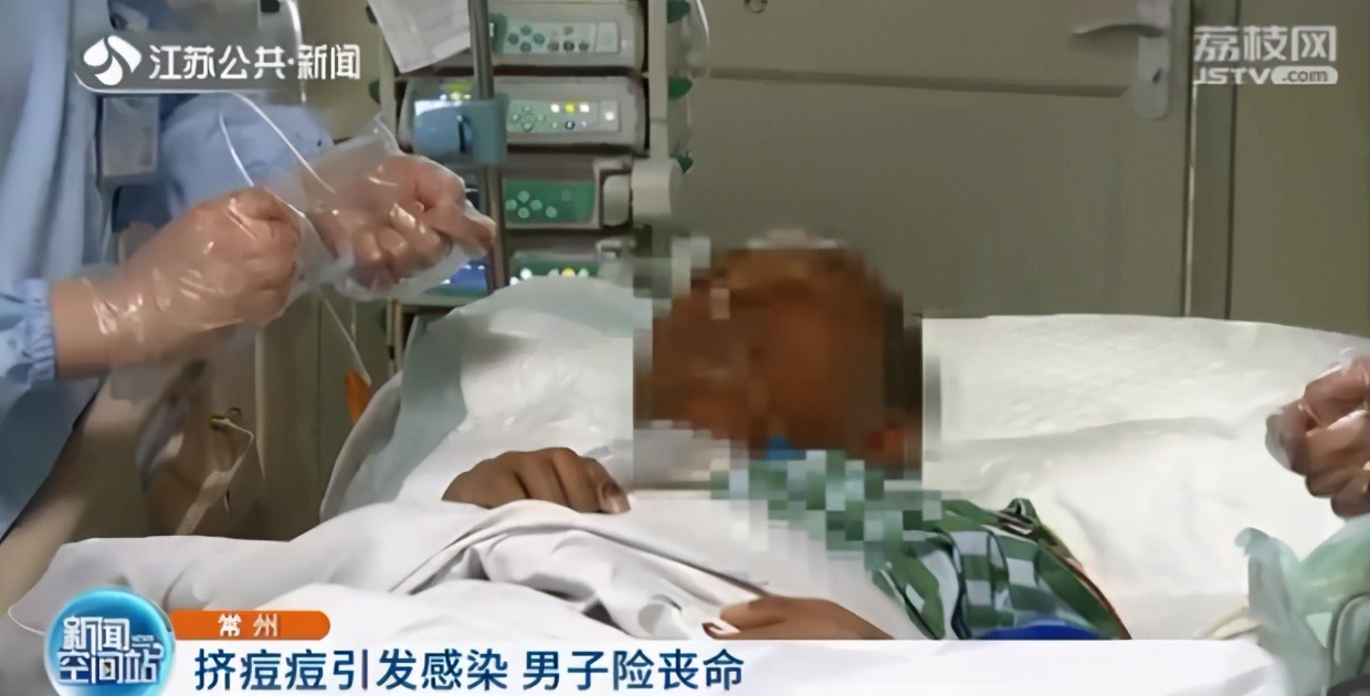 男子挤痘痘引发肺部严重感染 抢救时甚至用上“人工肺”ECMO
