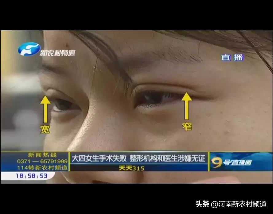 天天315 女大学生整形失败，3个月不敢出门