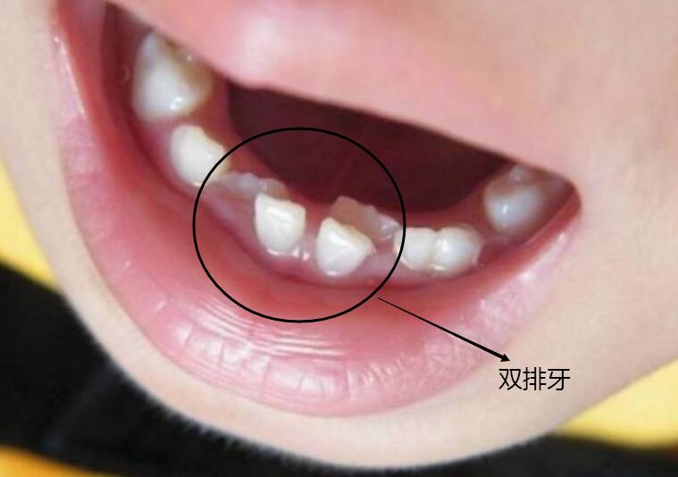 最全儿童换牙时间表：儿童换牙何时开始、何时结束？一图说清