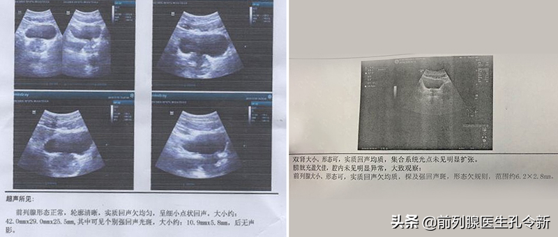 前列腺钙化要不要治？与其忐忑多疑拖长病程，不如早治早康复