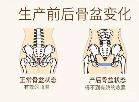 产后骨盆修复有必要？教练：这几种人一定要做