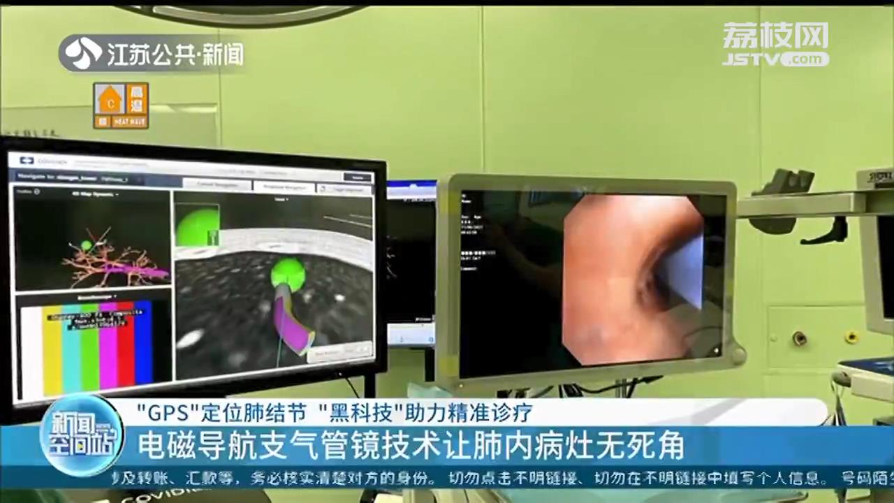 电磁导航定位肺结节，“黑科技”助力精准诊疗