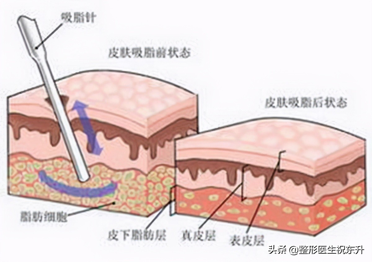 做了“自体脂肪填充面部”后，千万不能变胖？