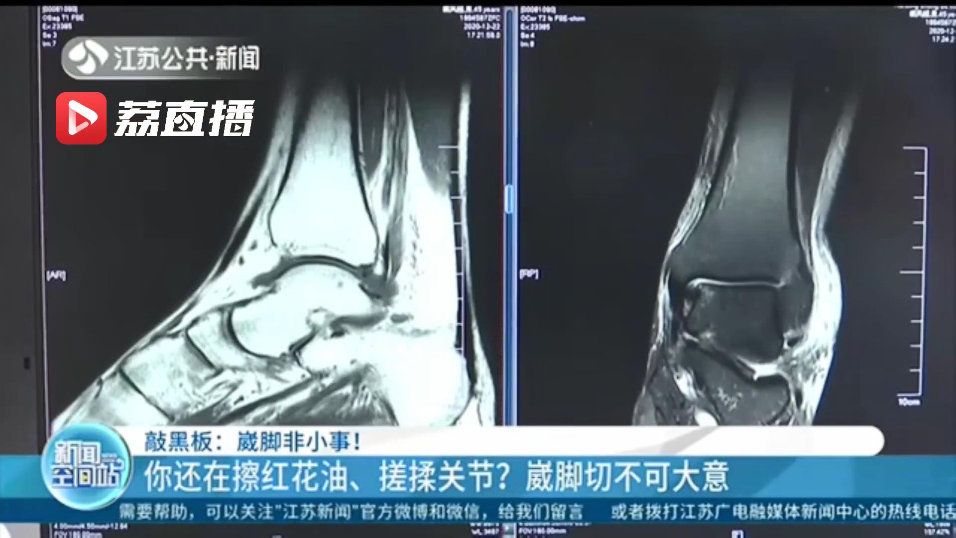 崴脚后还在擦药膏、搓揉关节？小心留下后遗症