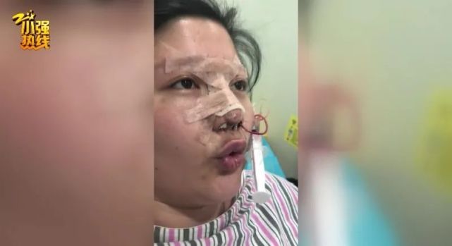 惨痛！杭州一女子鼻整形出意外，120紧急送医！画面不忍直视