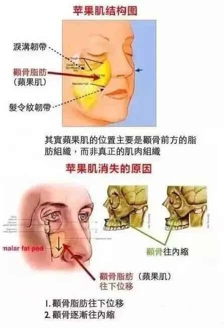 淚溝填充顯老 蘋果肌填充下垂 脂肪填充失敗有沒有 後悔藥 黎星醫生 Mdeditor