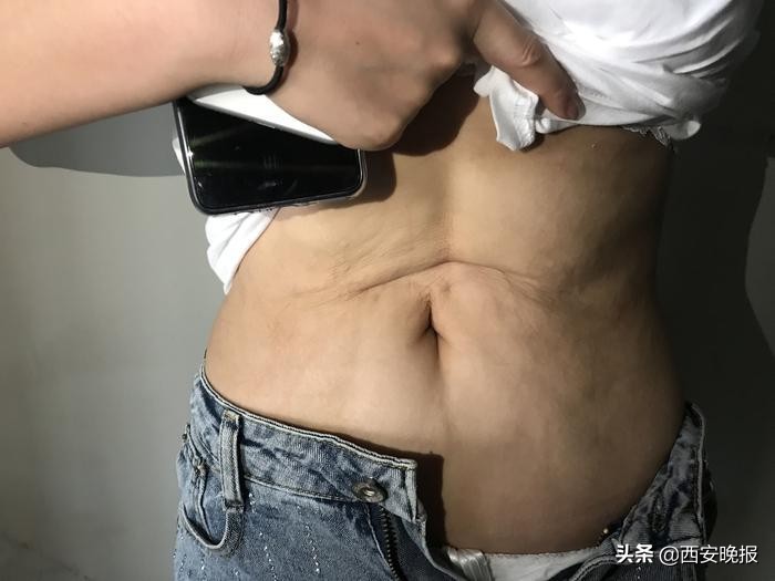 女子接受吸脂手术后腹部凹陷变形，维权遭遇举证难尴尬
