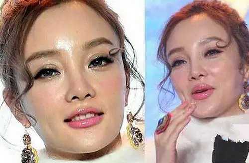 整容失败的10位明星，谁堪称“阴影”之最？