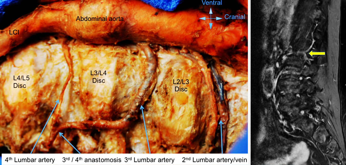 腰椎节段动脉解剖图片