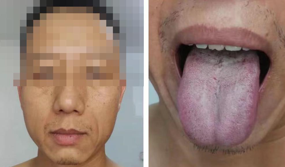 Folk Traditional Chinese Medicine There are teeth marks on the tongue, but the symptoms are