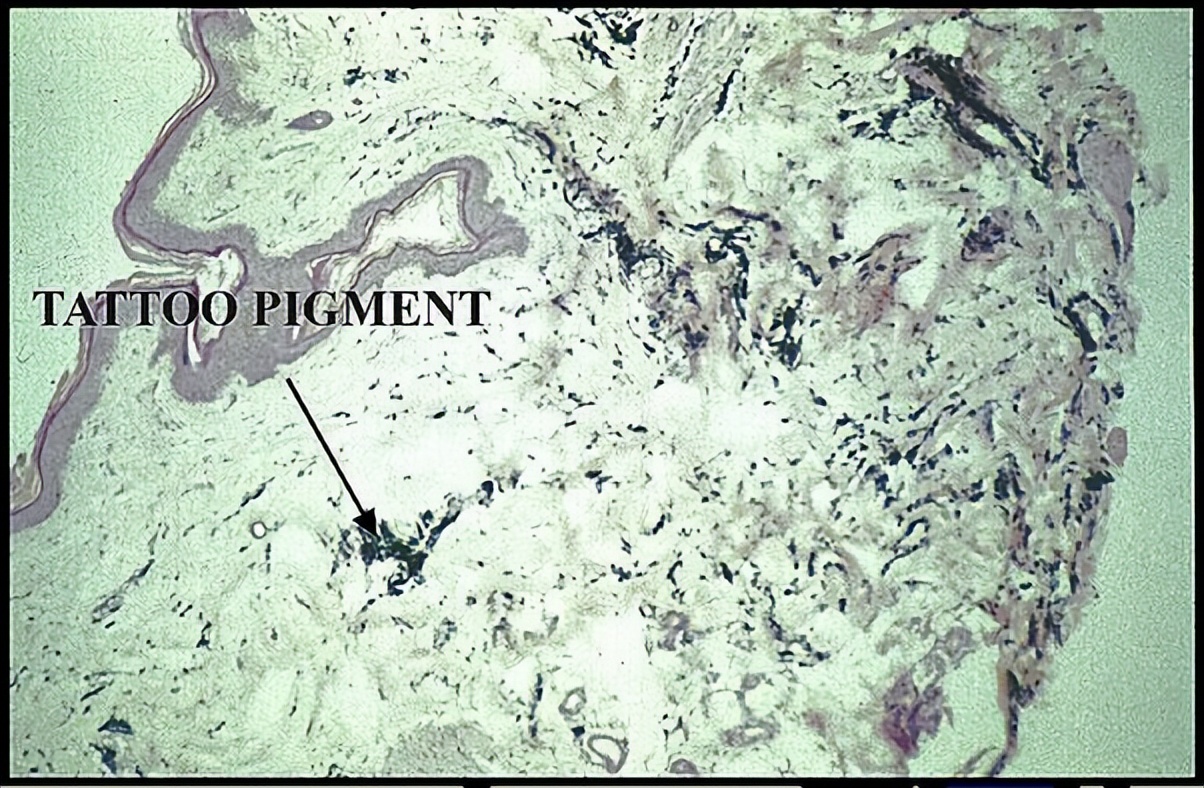 why-can-t-tattoos-be-removed-by-natural-replacement-of-skin-cells-inews