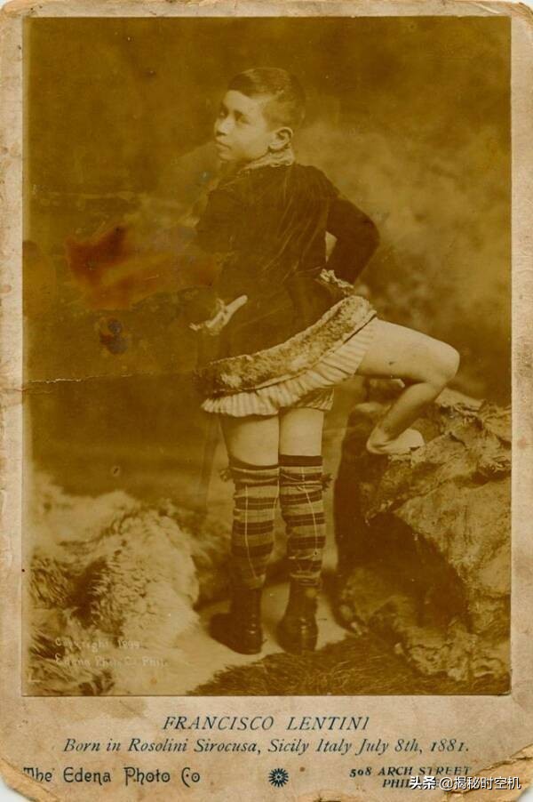 Anecdote A man with 3 legs and 2 reproductive systems, married two