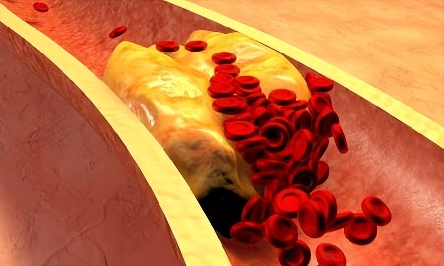 Eating 2 apples a day can effectively lower blood lipids?A followup