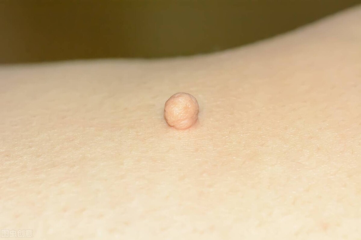 Small Fleshy Lump On Skin