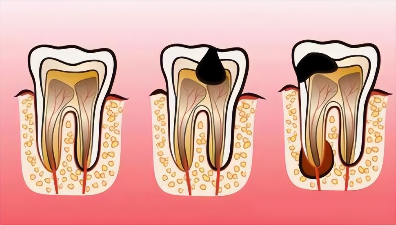 What is apical periodontitis and how is it treated? iNEWS