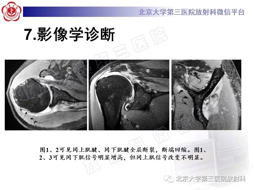 Good Article Sharing Imaging Diagnosis Of Suprascapular Nerve Compression Inews 6752