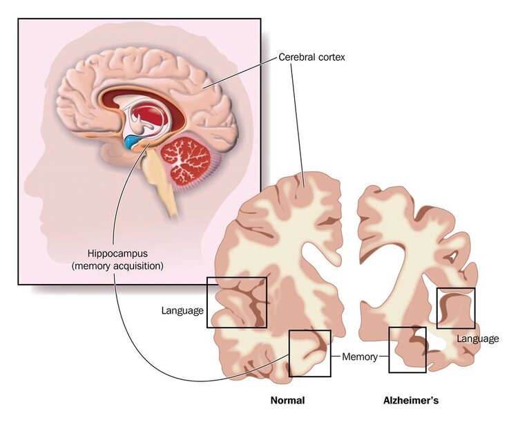 Different Blood Types Different Rates Of Brain Aging Which Blood Type Is More Prone To 
